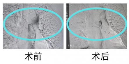 针对癌症引发的剧烈疼痛，别总想着靠吃药解