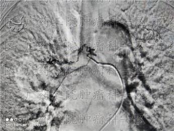 骨痛骨折发现癌转移?
