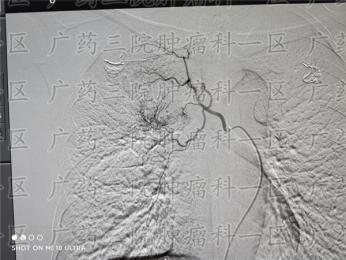 肺癌骨转移的治疗方案怎么选?