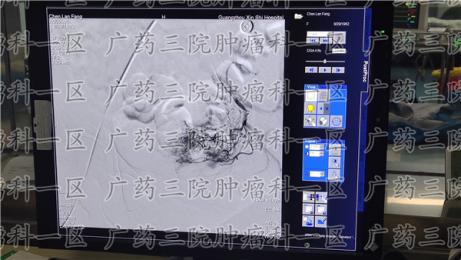 宫颈癌身体有啥反应？广药三院彭齐荣教授分