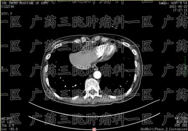宫颈癌粒子植入的治疗效果怎么样?广药三院
