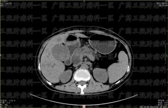 靶向治疗期间，癌症患者应如何从饮食方面下