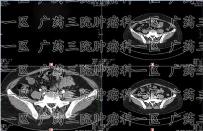 中期子宫癌还能治好吗