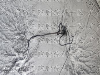 食管癌治疗：局部与整体并重