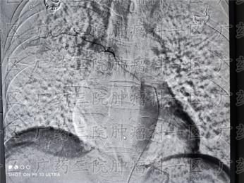 不同阶段的癌症，治疗侧重点不同,广药三院