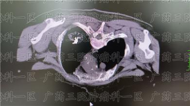 查出肺结节要不要治？应怎么治？