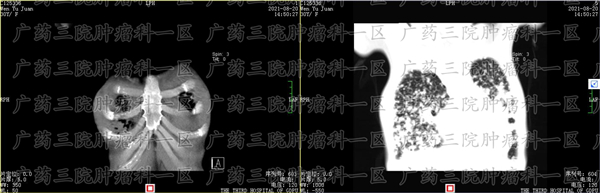 癌症骨转移疼痛与普通疼痛有什么区别？
