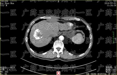不同分期的肝细胞癌怎么治疗?