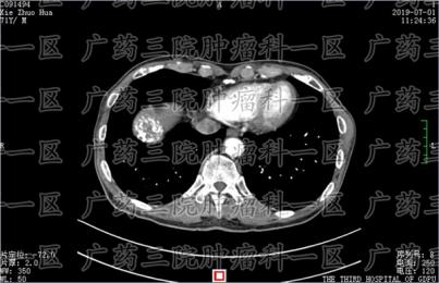 肝癌肺转移的治疗，广药三院肿瘤科一区：M