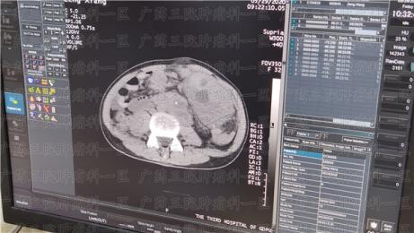 为什么肠癌肝转移患者不愿意传统化疗?