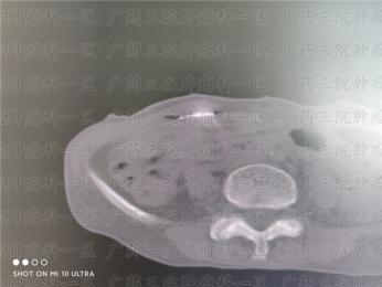 肠癌肝转移怎么确诊?