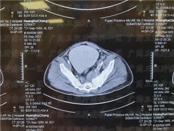 确诊肝转移，癌症患者如何选择治疗方案?