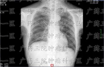 癌症晚期治不好，昂贵的化疗还有必要吗？