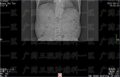 肝癌为什么会浑身发黄?