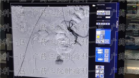 宫颈癌患者如何分辨正常月经与阴道出血?