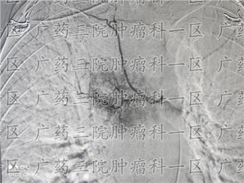 除了怕烫，食管还怕什么?