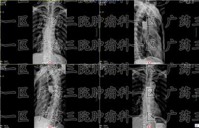 食管癌发病率居高不下