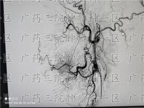 癌症本身并不可怕，可怕的是错误治疗