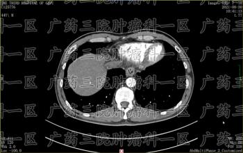 癌症到底是怎么得来的？省钱来的