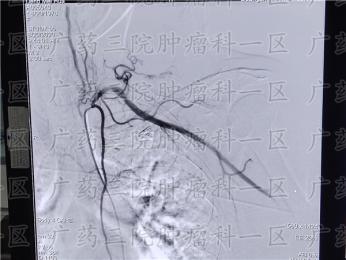 乳腺癌胸壁转移