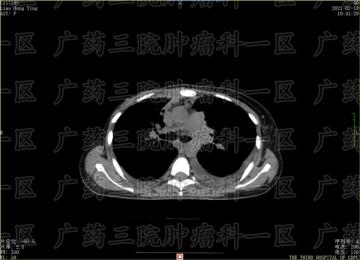 乳腺癌术后溃烂肿胀，警惕复发