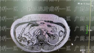 乳腺癌不及时治疗的危害，详解乳腺癌的4大