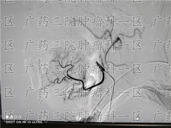 舌癌切除术后要做什么?