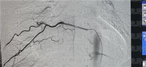 腹胀腹泻？先别急着吃胃药，有人吃出肝癌了