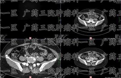 腹痛治疗后反复?