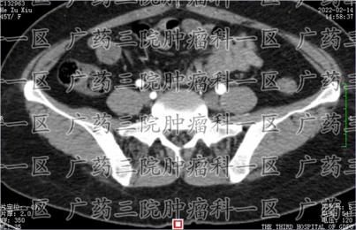 子宫切除后，子宫癌并没有离开