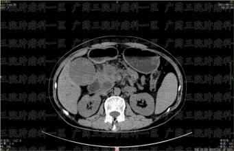 癌症病人什么情况下不适宜手术？出现这些症
