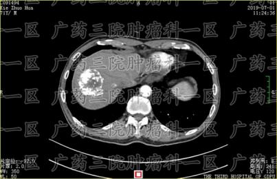 肝癌出现癌栓怎么办?