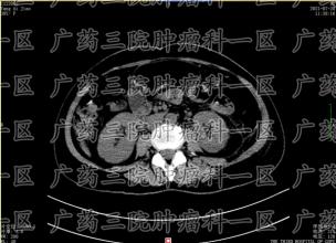 暂时出了点问题。化疗几天后会影响疗效吗？