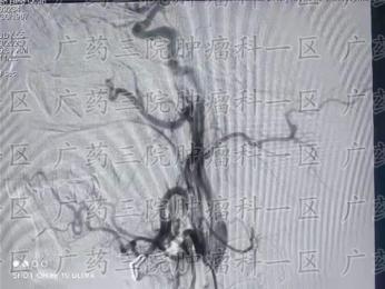 鼻咽癌肝多发转移很危险吗?
