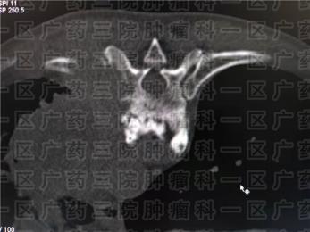 除了粒子，骨转移还可以做骨水泥