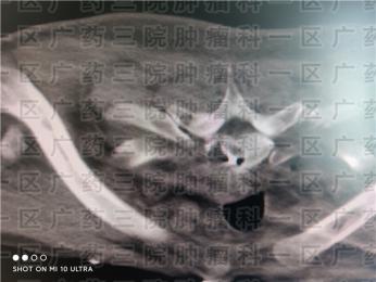 骨水泥可以治肿瘤吗?