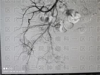 滑膜肉瘤用微创治疗真的有效吗