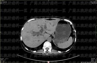 专家表示，肿瘤转移是治好肿瘤的难关