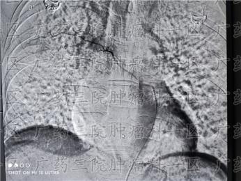 肺癌一直咳嗽不想化疗怎么治?