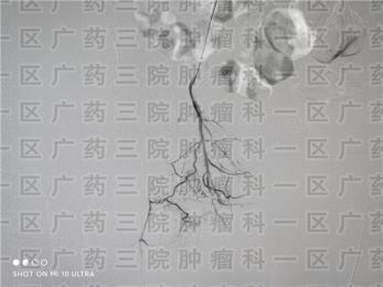 术后复发的滑膜肉瘤，冷冻消融