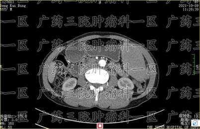 小淋巴细胞性淋巴瘤是手术好还是微创好