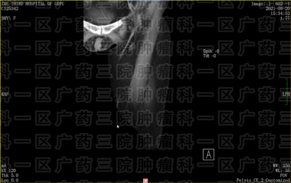 骨肉瘤末次化疗后又肿胀，是复发吗