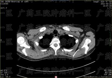 乳腺癌化疗的效果如何?