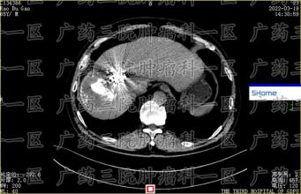 岁数大了，不想放化疗怎么办？