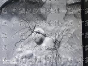 食道癌早期，身体可能会频繁给出4种“暗示