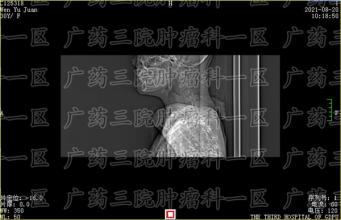 氩氦刀冷冻消融疗法能杀死肿瘤吗