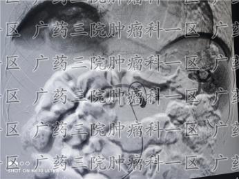 胃癌术后又患肝癌怎么办?广药三院肿瘤科一