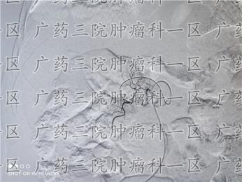 癌症术后胸背部疼痛，警惕骨转移。广药三院