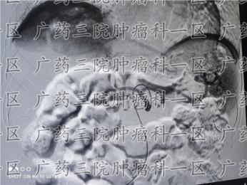 患过癌的人更要警惕腰背胸痛，广药三院肿瘤