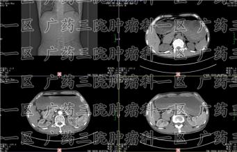 患过癌的人更容易得癌症吗?